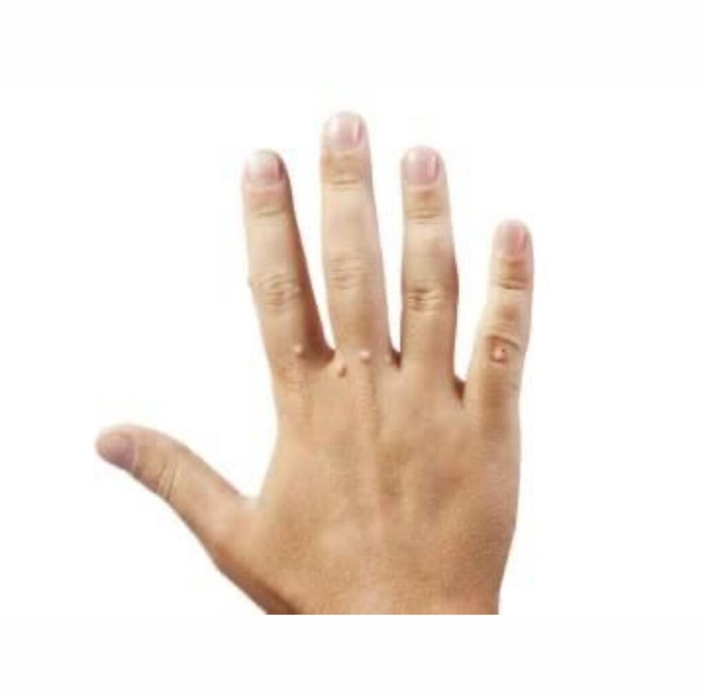 Tratamento de verrugas (olho de peixe)